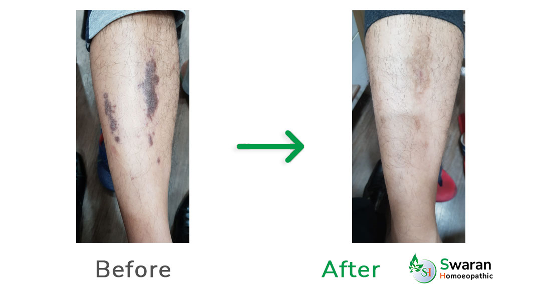 Leg Treatment Result Before & Affer