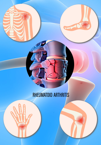 Rheumatoid-Arthritis-Inner